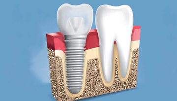 Research of the Russian market of biopolymer implants