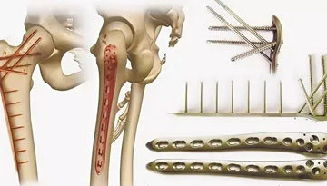 Study of the market of endoprostheses of large joints and products for osteosynthesis